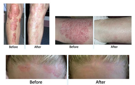 Does UV Light Treatment Help Psoriasis – A Psoriasis Phototherapy Guide