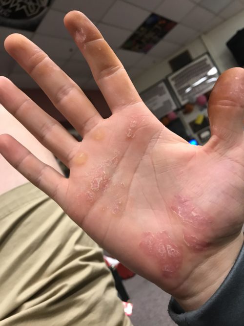 Psoriasis on Palm of Hand