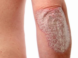 Managing the Psoriasis Itch