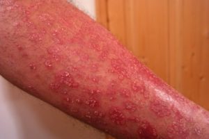 Managing the Psoriasis Itch