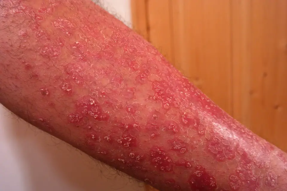 Best Over the Counter Psoriasis Cream (2018)- Psoriasis ...