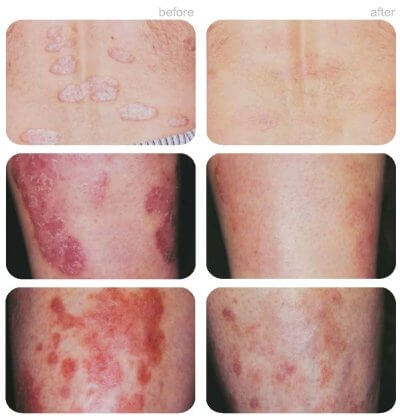 UV Light Treatment for Psoriasis