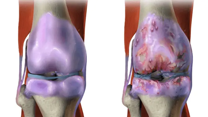 Osteoarthritis Osteoarthritis