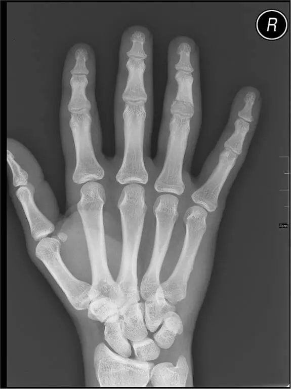 Psoriatic Arthritis x-ray increasing in Taiwan