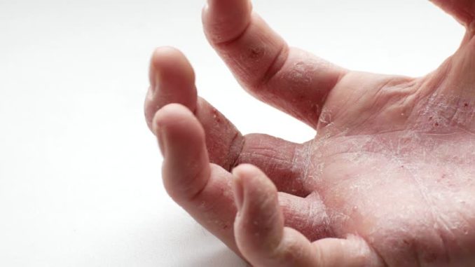 Psoriasis on Palm of Hands