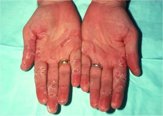 Psoriasis on Palm of Hands